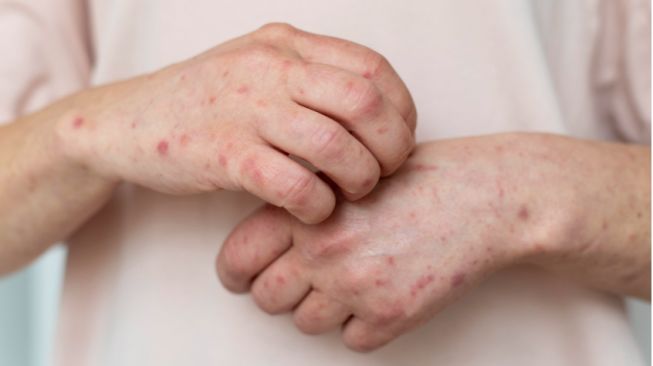 PASIEN SUSPEK CACAR MONYET (MONKEYPOX) DI JAWA TENGAH NEGATIF, TETAP WASPADA TERHADAP GEJALA DAN PENULARANNYA